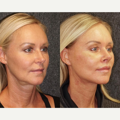 Facelift before and after photo