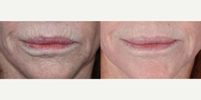 65-74 year old woman treated with ThermiSmooth - 65-74 year old woman treated with ThermiSmooth