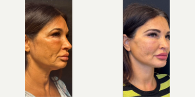 Woman treated with Lower Facelift - Woman treated with Deep Plane Facelift to lower face and Neck Lift. Patient is shown before and 6 weeks post-op.