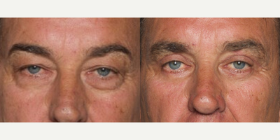 Man treated with Eyelid Surgery - This person scheduled a consult with Dr. Ho to discuss options to improve the upper and lower eyelid area. After his consult he elected to have surgery to rejuvenate the look of the area.