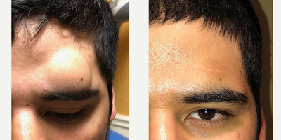 18-24 year old man treated with Lipoma Removal - This patient has a deforming large lipoma above his left eyebrow.  He is now seen 3 months post removal of this lipoma.  He has healed amazingly well.  The scar is barely noticeable and patient feels happy that he no longer has a deformity on his face any longer.