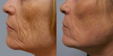 MiXto Laser Worth it? Reviews, Cost, Pictures - RealSelf