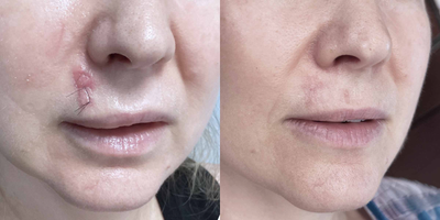 44 year old woman treated with Mohs Surgery - Moh's surgery performed on our 44-year-old female patient, after a month the scar is continuing to heal but any visible remnants of scarring are already disappearing!