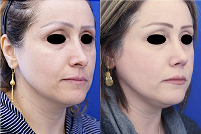 45-54 year old woman treated with Revision Rhinoplasty - This lady with a prior rhinoplasty has an over-resected nose with a hanging columella and distorted tip morphology. Revision rhinoplasty is carried out to restore a more natural appearance. Tongue in groove technique corrects the hanging columella.