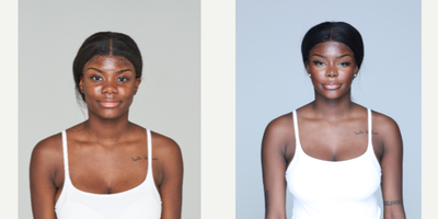 25-34 year old woman treated with Cheekbone Reduction - cheekbone reduction, jaw angle reduction, genioplasty