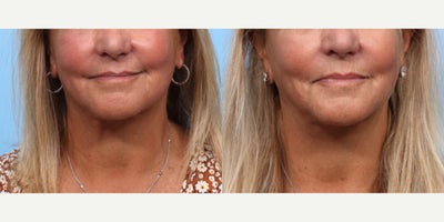 65-74 year old woman treated with Ultherapy - This patient had Ultherapy on her lower face and neck to lift and tighten the skin.