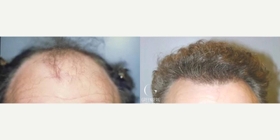 Man treated with Hair Loss Treatment - Man treated with Hair Loss Treatment through NeoGraft Hair Restoration