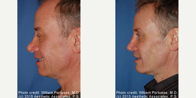 Man treated with Cheek Implants - Man treated with Cheek Implants