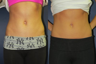 Umbilicoplasty - Belly Button Surgery