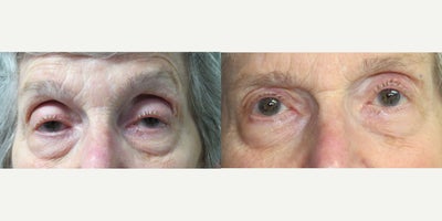 75 and up year old woman treated with Ptosis Surgery - Upper Eyelid Levator Advancement for Ptosis