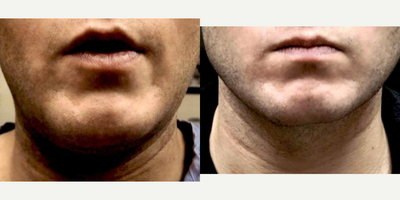 25-34 year old man treated with PrecisionTx - Before and after Precision Tx procedure.