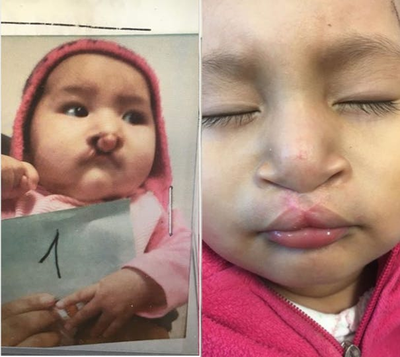 Woman treated with Cleft Lip And Palate Repair - Woman treated with Cleft Lip And Palate Repair