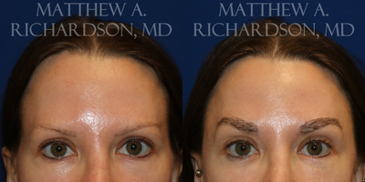 45-54 year old woman treated with Eyebrow Transplant - 45-54 year old woman treated with Eyebrow Transplant. Photos are at 6 months post-op.
