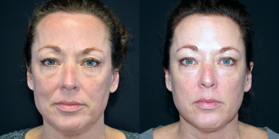 45-54 year old woman treated with Bellafill - 46 year old female received Bellafill to infraorbicular area, nasolabial folds, temples, zygomatic arch and under eyes.
