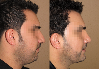 Neck liposuction using laser technique and rhinoplasty with chin augmentation - 
	Laser liposuction of the neck, chin augmentation and rhinoplasty - dramatic impact on the appearance of the face
