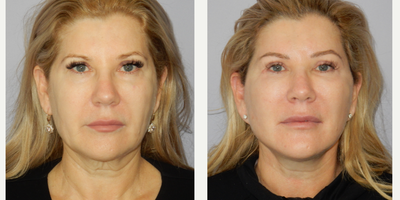 55-64 year old woman treated with Facelift, MACS Facelift, Brow Lift, Eyelid Surgery - 56 yo female requesting facial rejuvenation. Modified extended MACS facelift, browlift, lower lid blepharoplasty.
