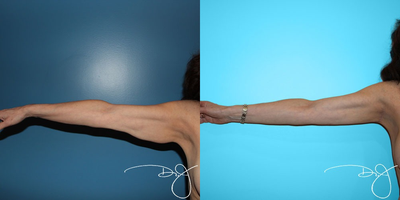 55-64 year old woman treated with Arm Lift - Mini arm lift to treat hanging skin and excess fat
