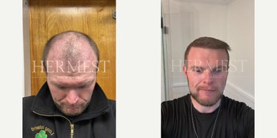 25-34 year old man treated with DHI Hair Transplant - 9-month post-op results for our patient from the USA. Total count: 3,876 grafts. Technique: DHI Method.