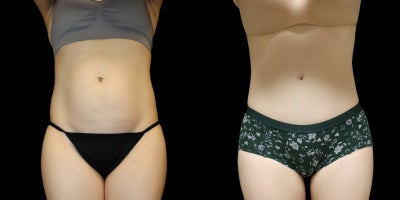 34 year old woman treated with Tummy Tuck - This fit mother of two was troubled by the separation of her large anterior abdominal muscles. For most women, this natural separation will heal and close itself soon after giving birth without any help or intervention. In some cases, the gap between these two abdominal muscles will persist months of even years after. We decided on an abdominoplasty with muscle repair and liposuction of her waist and inner thighs to address her concerns. Height: 5'0 Weight: 118lbs.