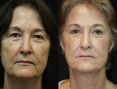 63 year old woman treated with Obagi Nu-Derm - 63 year old patient concerned with a prematurely aged and tired looking eyes, face, and neck. The doctor performed upper and lower eyelids surgery, facelift, necklift, neck liposuction, SMAS repair, and fillers.