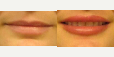25-34 year old woman treated with Lip Implants (upper and lower) - This patient came to see me because she wanted a more permanent solution for fuller, natural appearing lips.  After discussing her goals and concerns, I developed a treatment plan for her that involved placing a medium size perma-lip implant into the upper and lower lip. Her recovery was very quick.  After 4 days, as the swelling was resolving, she felt comfortable going out with lipstick on. Her pictures are 1 month postop.