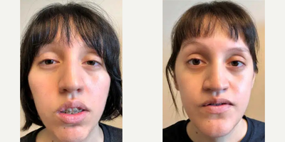 Woman treated with Jaw Surgery - Woman treated with Jaw Surgery