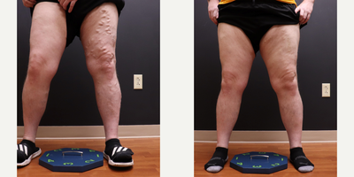35-44 year old man treated with Sclerotherapy - 2 Ultrasound guided sclerotherapy treatments performed to patients varicose veins.