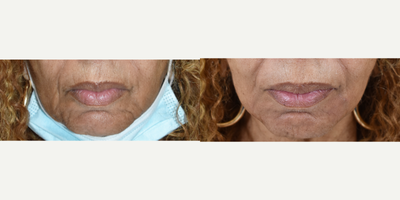 Los Angeles dermal filler before and after photos for mouth - She said, I don't want to give up on looking pretty.  Sometimes a little smoothing can go a long way.  Hyaluronic acid based products like Restylane Lyft and or Restylane Defyne can go a long way toward correcting volume loss and aging around the mouth.