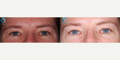 45-54 year old woman treated with Fraxel Repair - The upper eyelids lift a little and open up the eyes thanks to the lifting effect of Botox injected in the glabella of the forehead (between the eyebrows).