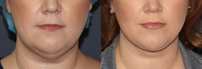 55-64 year old woman treated with ThermiTight - This 40 year old patient is 6 weeks out from one Thermitight treatment with Dr. Groff. Notice the dramatic tightening and contouring of neck!