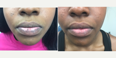 18-24 year old woman treated with Enlighten - A condition called oral melanotic nevi of the lips treated with one session of the enlighten&trade; for hyperpigmentation