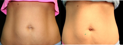 35-44 year old woman treated with UltraShape - 9 weeks post 3 treatments of UltraShape.