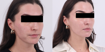 25-34 year old woman treated with Microneedling RF, Moxi - Patient is 6 weeks out after 1st session of RF Microneedling and Moxi to address uneven skin tone, uneven skin texture and acne scarring. Patient has 2 more sessions to go.