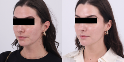 25-34 year old woman treated with Microneedling RF, Moxi - Patient is 6 weeks out after 1st session of RF Microneedling and Moxi to address uneven skin tone, uneven skin texture and acne scarring. Patient has 2 more sessions to go.
