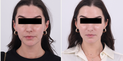 25-34 year old woman treated with Microneedling RF, Moxi - Patient is 6 weeks out after 1st session of RF Microneedling and Moxi to address uneven skin tone, uneven skin texture and acne scarring. Patient has 2 more sessions to go.