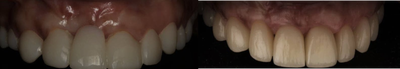 25-34 year old woman treated with Dental Implants - Patient lost her anterior front tooth #8 in auto accident and chipped other front teeth , had bad dental treatment and presented to my office with the before condition, anterior implant and crowns was placed to replace missing tooth #8 as well enhance her smile.
