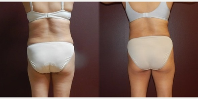 UltraSlim - Woman treated with UltraSlim