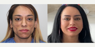 Woman treated with Facial Fat Transfer - Woman treated with Facial Fat Transfer