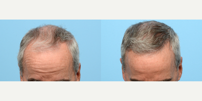 65-74 year old woman treated with FUE Hair Transplant, Hair Transplant, Hair Loss Treatment, PRP for Hair Loss, PRP Injections - 65-year-old male was presenting with traditional male pattern baldness. Patient desired hair at his receding hairline. To address increasing the volume of hair to his hairline, a follicular unit extraction (FUE) was utilized to harvest the hair follicles. The procedure involved a total of 3,050 grafts placed throughout the frontal and hairline and one treatment of PRP therapy.