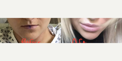 Woman treated with Lip Lift - Woman treated with Lip Lift