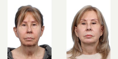 Woman treated with Chin Liposuction, Deep Plane Facelift, Facial Fat Transfer - Woman treated with Chin Augmentation, Deep Plane Facelift, Facial Fat Transfer