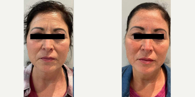 45-54 year old woman treated with Potenza - Potenza RF microneedling with PRP. No downtime, slightly red for a few hours after treatment. Minimal discomfort during procedure, no pain after procedure. Numbing cream is optional. Procedure time 30-40 min.