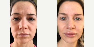 Woman treated with Botox - Patient started preventative Botox 2 years ago and has noticed an overall improved facial contour. Botox is an easy and effective solution to reduce the appearance of lines and wrinkles