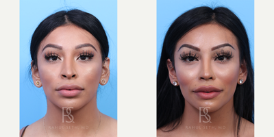 25-34 year old transgender woman treated with Facial Feminization Surgery, Transgender Facial Feminization Surgery - Revision facial feminization surgery with focus on the nose and cheeks