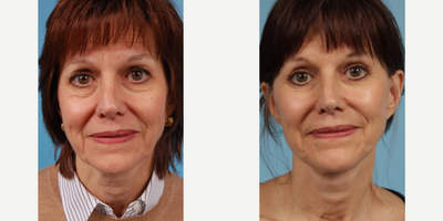 Woman treated with Lower Facelift - Woman treated with Lower Facelift