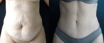 Belly Button Surgery after Tummy Tuck - Belly Button Surgery  After Tummy Tuck