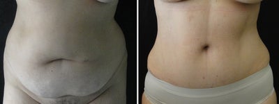 Belly Button Surgery after Tummy Tuck - Belly Button Surgery - Tummy Tuck