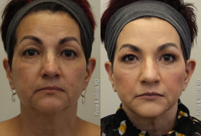 55-64 year old woman treated with AccuTite - accutite to brows, lids, jowls, nasolabial folds. morpheus 8 with PRF as well.