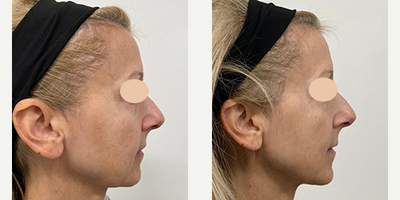 45-54 year old woman treated with CoolPeel - This patient has 2 Vivace and CoolPeel treatments for the full face. After is 1 month following the second treatment.