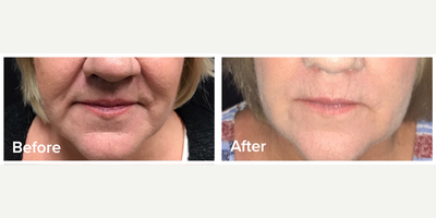 55-64 year old woman treated with Plasma Pen - Now available at The Lifestyle Center in St. Louis, this revolutionary treatment lifts, tightens, and rejuvenates skin non-invasively. Registered with the FDA, the Plasma Pen Ultra Device delivers incredibly natural-looking results that last for up to 3 years. Best of all, you can get back to your life even faster with a shorter downtime and recovery!